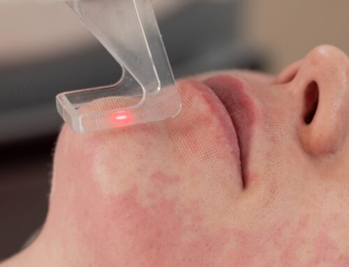 Boosting Recovery Speeds with HBOT for Cosmetic Procedures: A Focus on Laser Skin Resurfacing